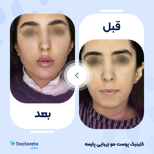تزریق ژل گونه با برند درمال استایل (1cc)