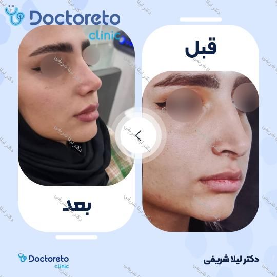 عمل زیبایی بینی (رینوپلاستی)