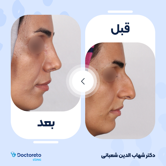 عمل جراحی مجدد زیبایی بینی (رینوپلاستی) دکتر شهاب الدین شعبانی در مشهد 35