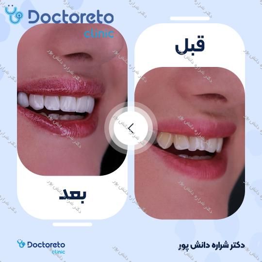 جرمگیری دو فک با بروساژ