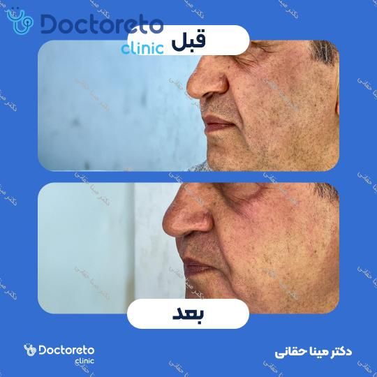 جوانسازی، آبرسانی و کلاژن سازی صورت با مزوژل جالپرو HMW صورتی (هر جلسه) دکتر مینا حقانی در اصفهان 5