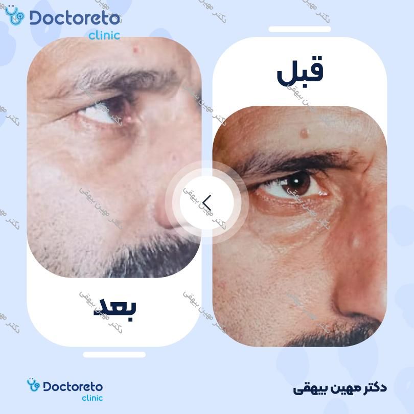 برداشتن خال کوچک با دستگاه Vulkan (Licht) (هر عدد)