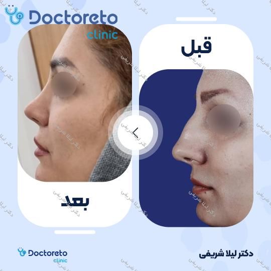 عمل زیبایی بینی (رینوپلاستی)