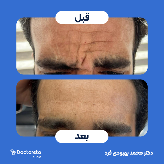 تزریق بوتاکس صورت (پیشانی ،خط اخم،دورچشم) با برند مصپورت دکتر محمد بهبودی فرد در مشهد 3