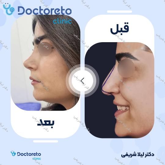 عمل زیبایی بینی (رینوپلاستی)