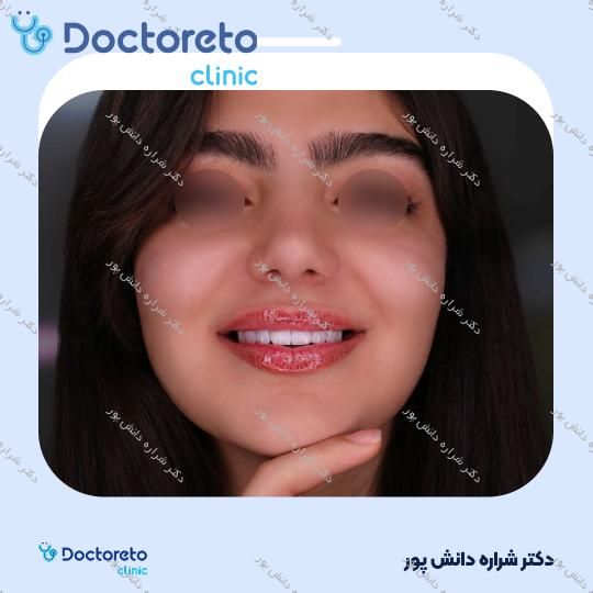 ونیر کامپوزیت الترادنت آمریکایی (هر واحد)