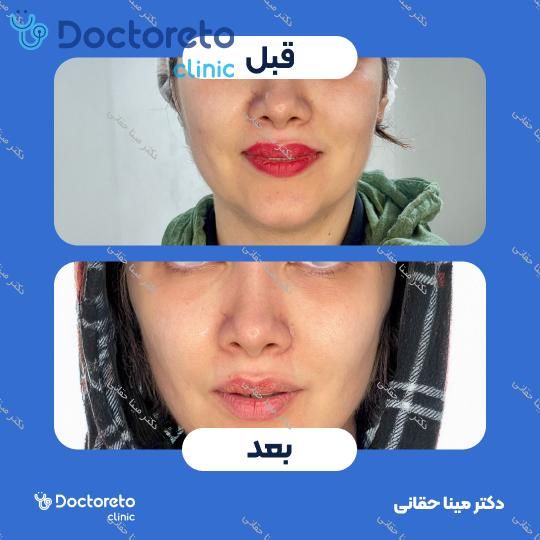 جوانسازی، آبرسانی و کلاژن سازی صورت با مزوژل جالپرو HMW صورتی (هر جلسه) دکتر مینا حقانی در اصفهان 2