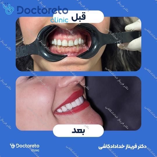 لمینت سرامیکی ips (هر واحد)