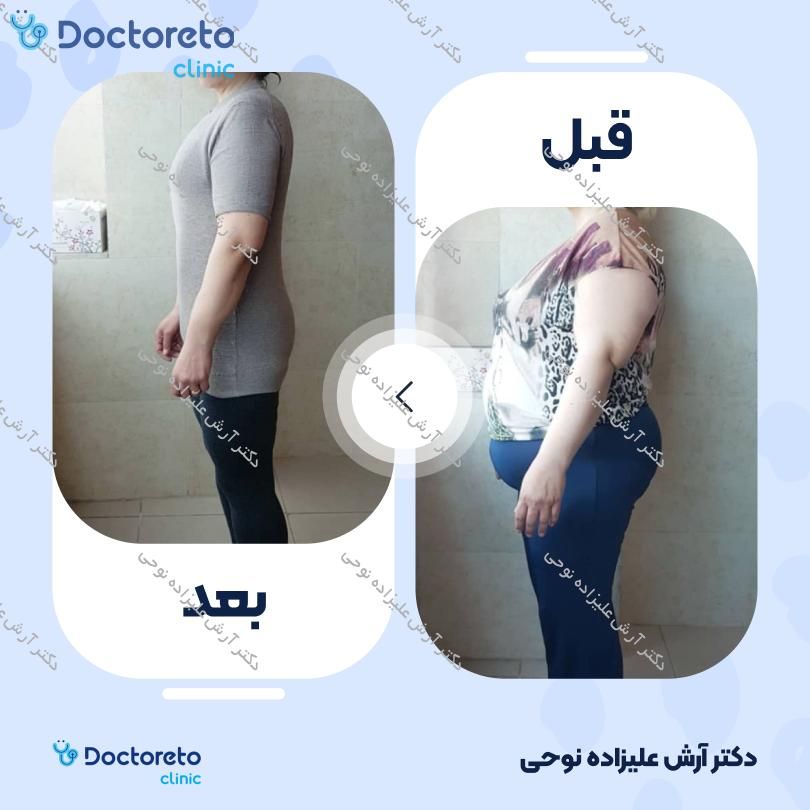 لاغری موضعی به روش طب سوزنی ، دستگاه کویتیشن ، رژیم ( 12 جلسه ، 30 دقیقه ای ) دکتر آرش علیزاده نوحی در شاهین شهر 11
