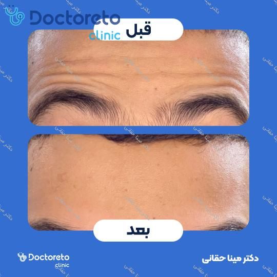 تزریق بوتاکس صورت (پیشانی، خط اخم، پنجه کلاغی) با برند مصپورت دکتر مینا حقانی در اصفهان 5