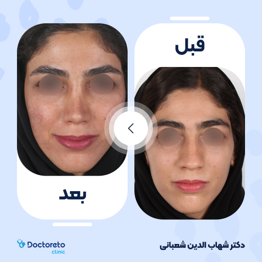 عمل زیبایی بینی (رینوپلاستی) دکتر شهاب الدین شعبانی در مشهد 22