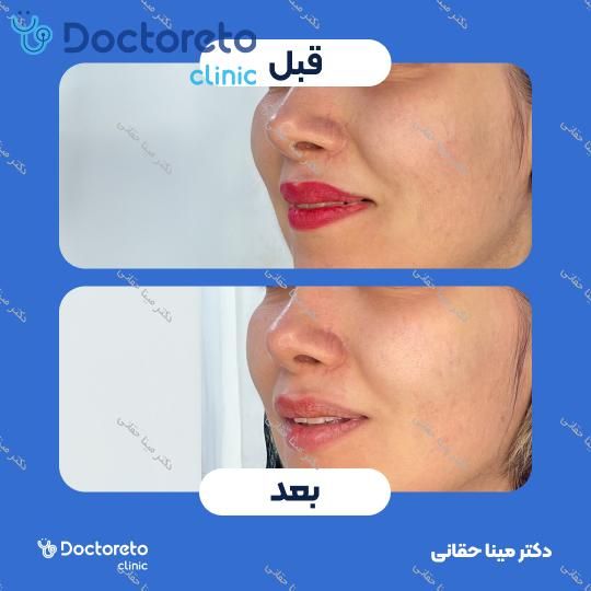 جوانسازی، آبرسانی و کلاژن سازی صورت با مزوژل جالپرو HMW صورتی (هر جلسه) دکتر مینا حقانی در اصفهان 4