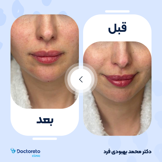 تزریق ژل لب با برند رووفیل پلاس (1cc) دکتر محمد بهبودی فرد در مشهد 6