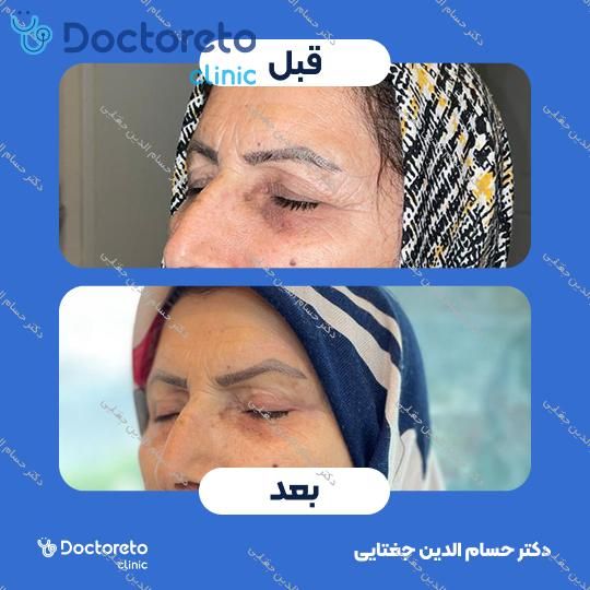 بلفاروپلاستی پلک بالا به روش جراحی دکتر حسام الدین جغتایی در ساری 11