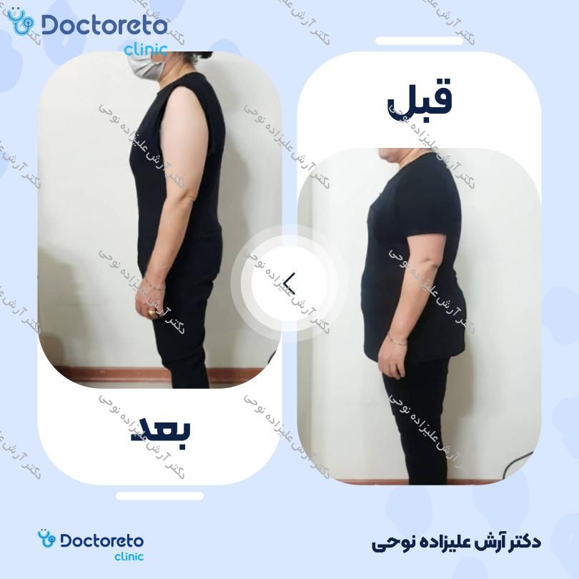 لاغری موضعی به روش طب سوزنی ، دستگاه کویتیشن ، رژیم ( 12 جلسه ، 20 دقیقه ای ) دکتر آرش علیزاده نوحی در شاهین شهر 3