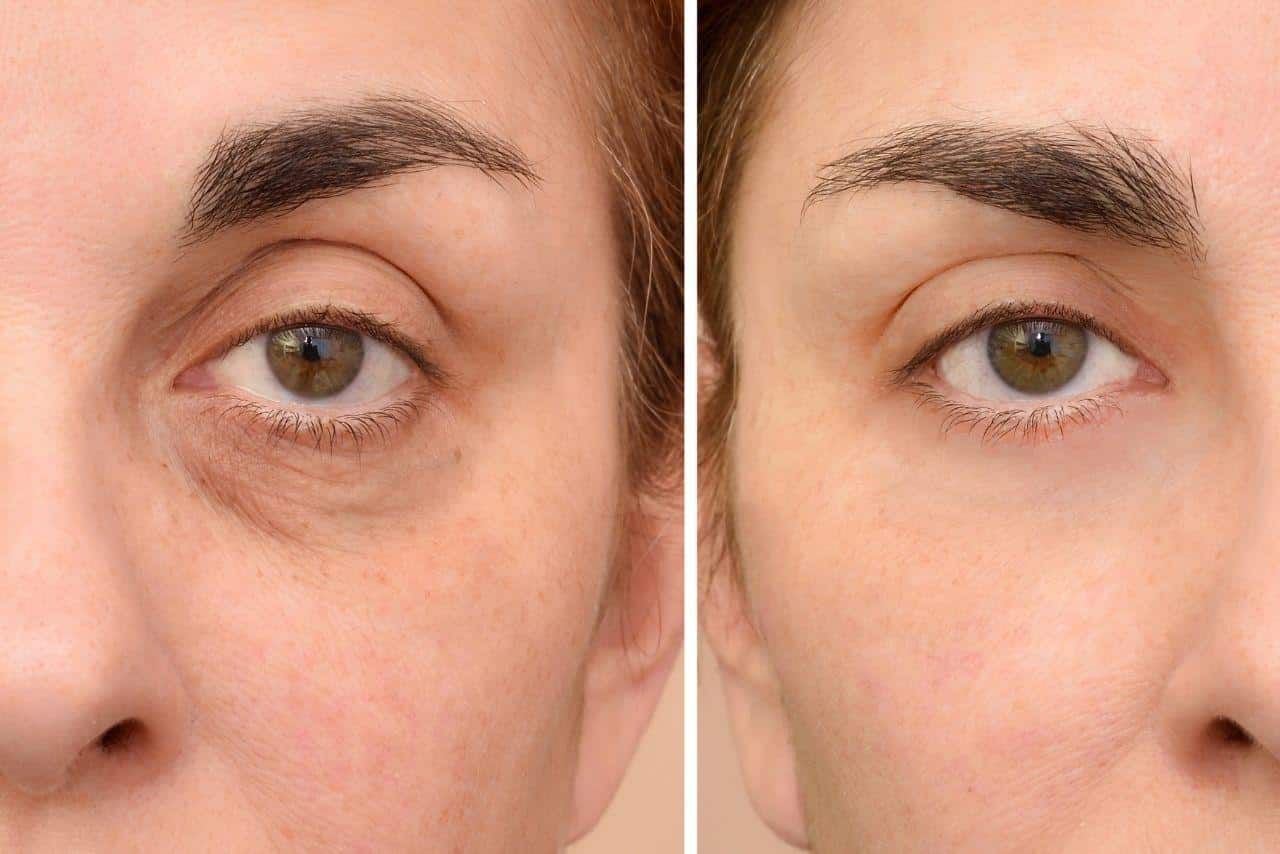 تزریق ژل زیر چشم با برند نئوویا (1cc)