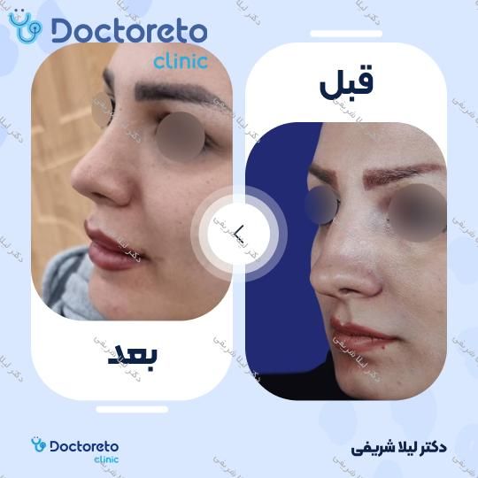 عمل زیبایی بینی (رینوپلاستی)