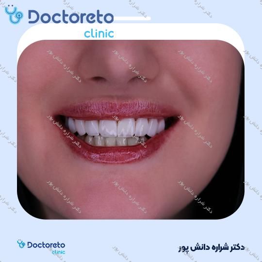 ونیر کامپوزیت الترادنت آمریکایی (هر واحد)