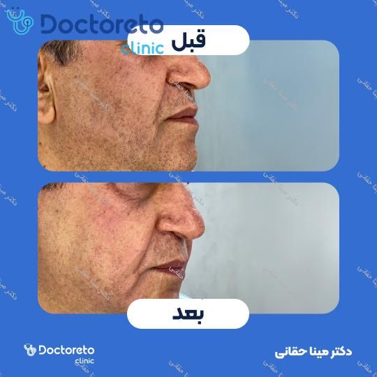 جوانسازی، آبرسانی و کلاژن سازی صورت با مزوژل جالپرو HMW صورتی (هر جلسه) دکتر مینا حقانی در اصفهان 6