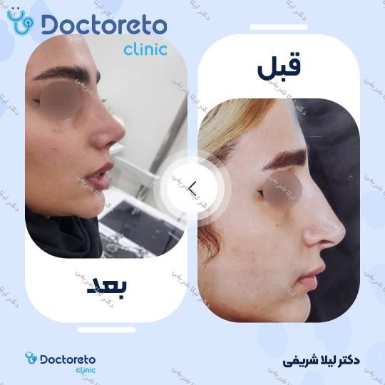 عمل زیبایی بینی (رینوپلاستی)