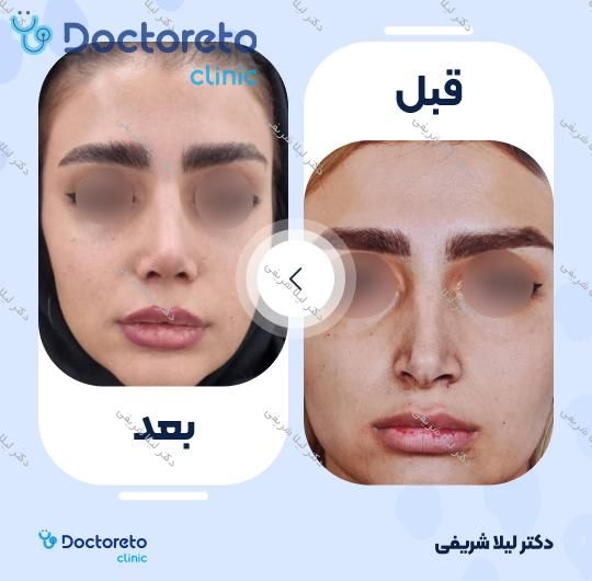 عمل زیبایی بینی (رینوپلاستی)