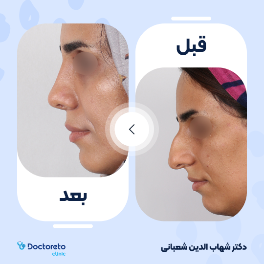 عمل زیبایی بینی (رینوپلاستی) دکتر شهاب الدین شعبانی در مشهد 32