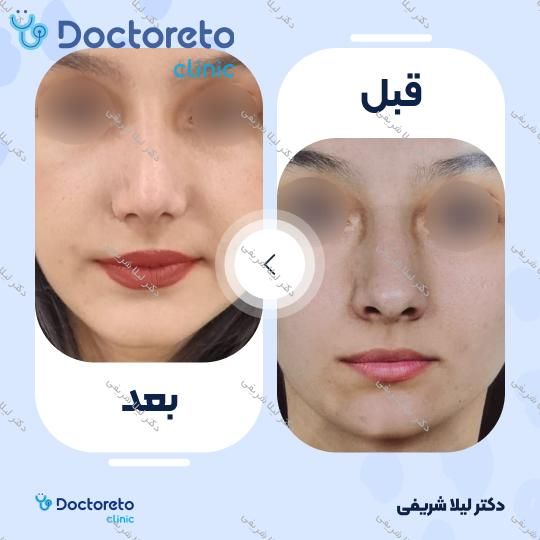 عمل زیبایی بینی (رینوپلاستی)