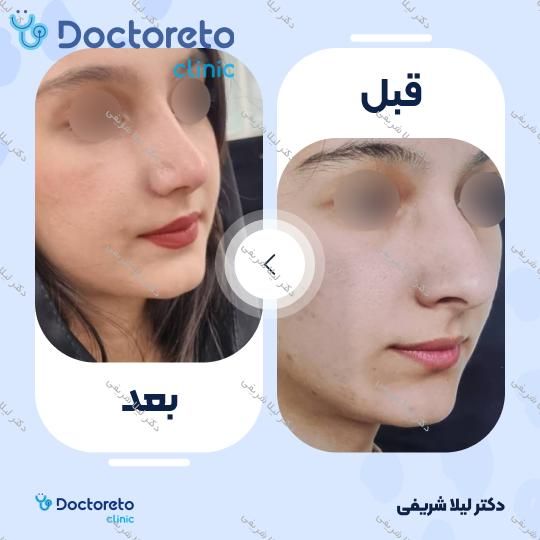 عمل زیبایی بینی (رینوپلاستی)