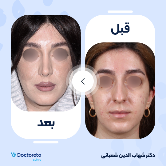 عمل جراحی مجدد زیبایی بینی (رینوپلاستی) دکتر شهاب الدین شعبانی در مشهد 27