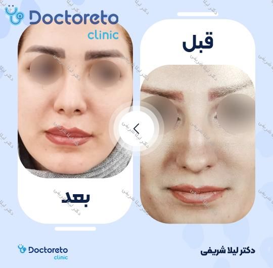 عمل زیبایی بینی (رینوپلاستی)