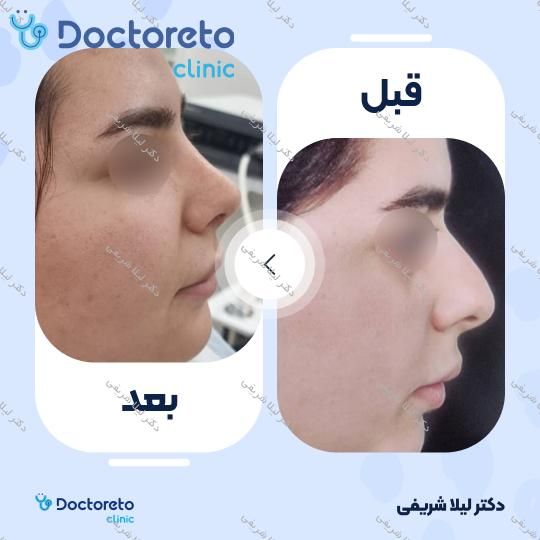 مشاوره جراحی انحراف بینی (سپتوپلاستی)
