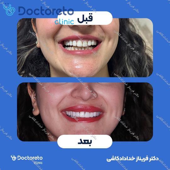 لمینت سرامیکی ips (هر واحد)