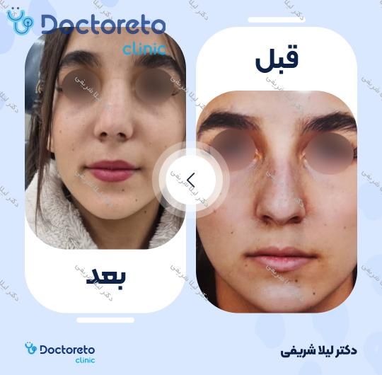 عمل زیبایی بینی (رینوپلاستی)