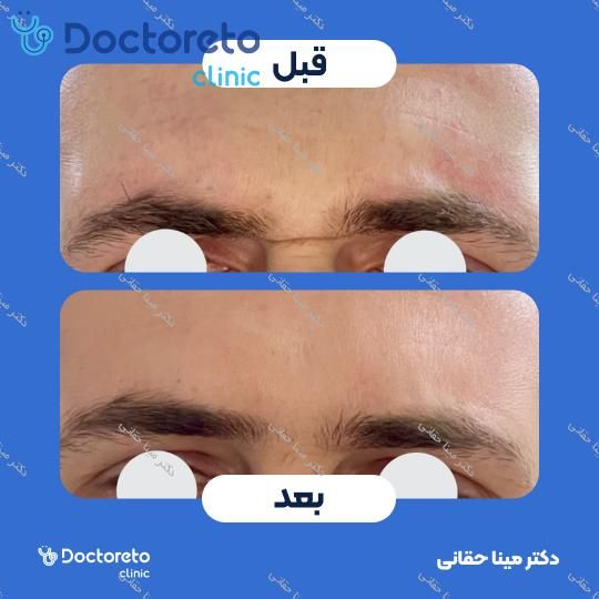 تزریق بوتاکس صورت (پیشانی، خط اخم، پنجه کلاغی) با برند مصپورت دکتر مینا حقانی در اصفهان 8