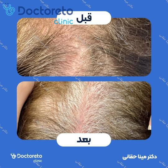 مزوتراپی موی سر با برند رویتاکر (1cc)
