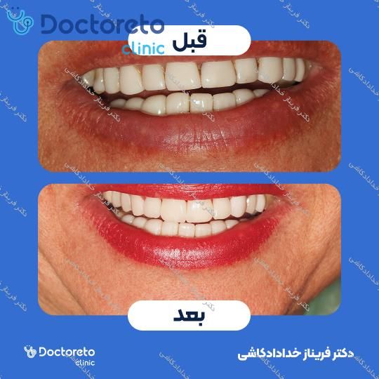 لمینت سرامیکی ایمکس آلمان به همراه تکسچر (هر واحد)