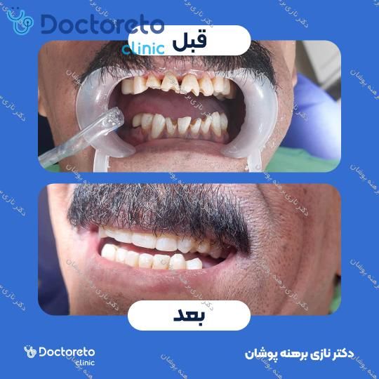 ونیر کامپوزیت اولترادنت آمریکایی (هر واحد) دکتر نازی برهنه پوشان در تهران 19