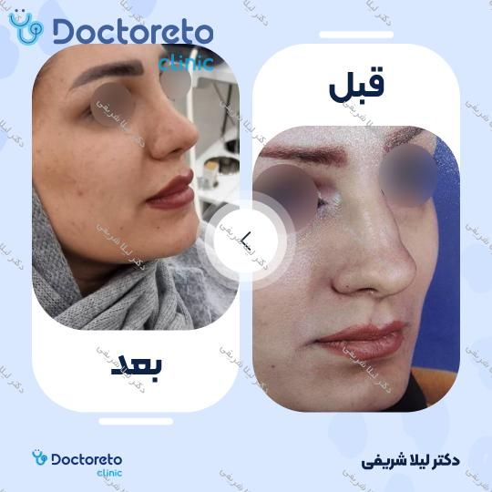 عمل زیبایی بینی (رینوپلاستی)