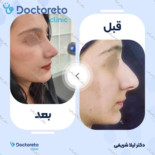 عمل زیبایی بینی (رینوپلاستی)
