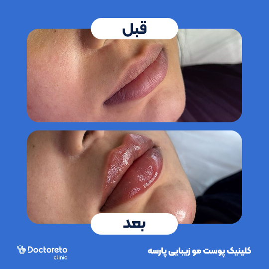تزریق ژل لب با برند الانسه (1cc)