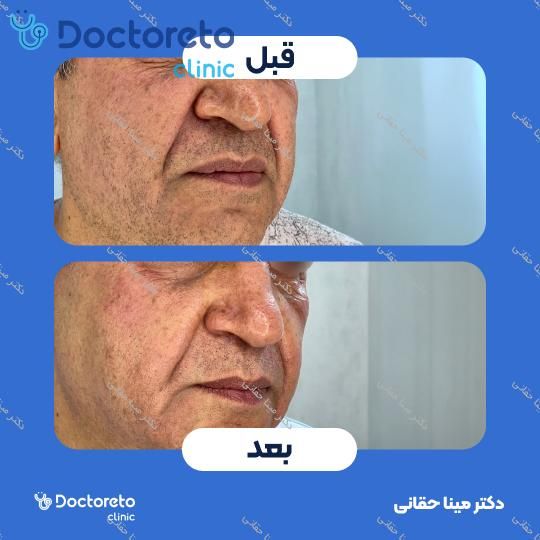 جوانسازی، آبرسانی و کلاژن سازی صورت با مزوژل جالپرو HMW صورتی (هر جلسه) دکتر مینا حقانی در اصفهان 7