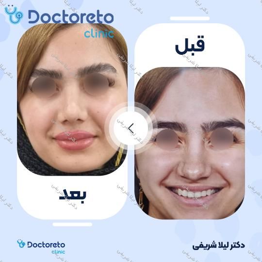 عمل زیبایی بینی (رینوپلاستی)