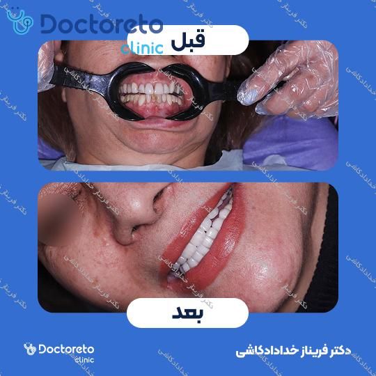 لمینت سرامیکی ایمکس آلمان به همراه تکسچر (هر واحد)