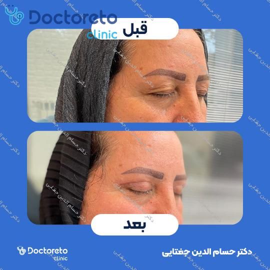 بلفاروپلاستی پلک بالا به روش جراحی دکتر حسام الدین جغتایی در ساری 14