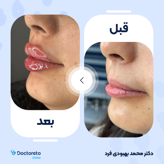 تزریق ژل لب با برند رووفیل پلاس (1cc) دکتر محمد بهبودی فرد در مشهد 7
