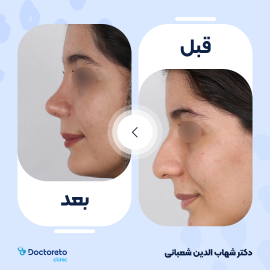 عمل زیبایی بینی (رینوپلاستی) دکتر شهاب الدین شعبانی در مشهد 29