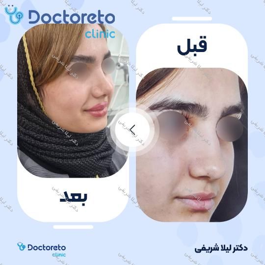 عمل زیبایی بینی (رینوپلاستی)