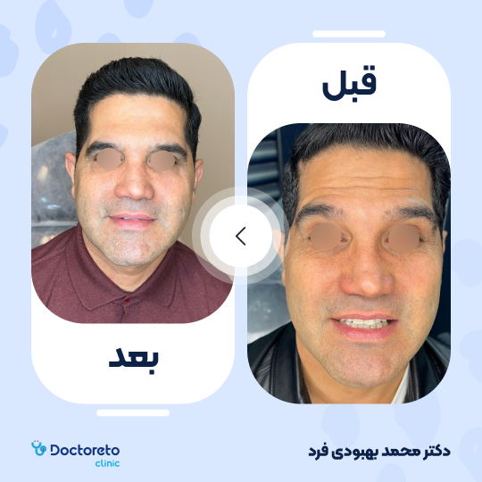 تزریق بوتاکس صورت (پیشانی ،خط اخم،دورچشم) با برند مصپورت
