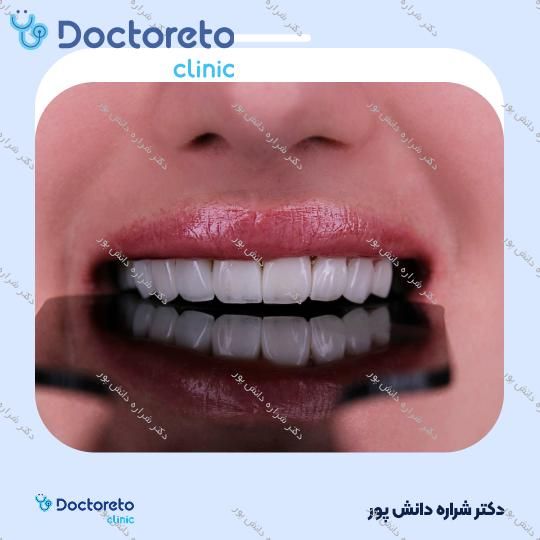ونیر کامپوزیت سارمکو سوئیس (هر واحد) دکتر شراره دانش پور در تهران 2