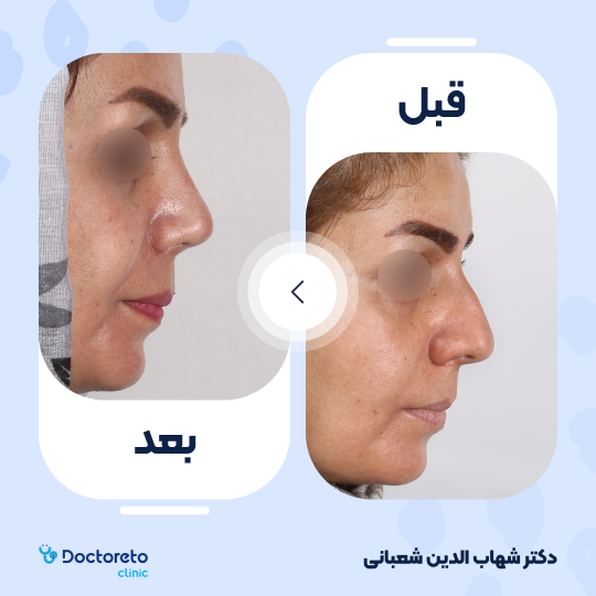 عمل جراحی مجدد زیبایی بینی (رینوپلاستی) دکتر شهاب الدین شعبانی در مشهد 36
